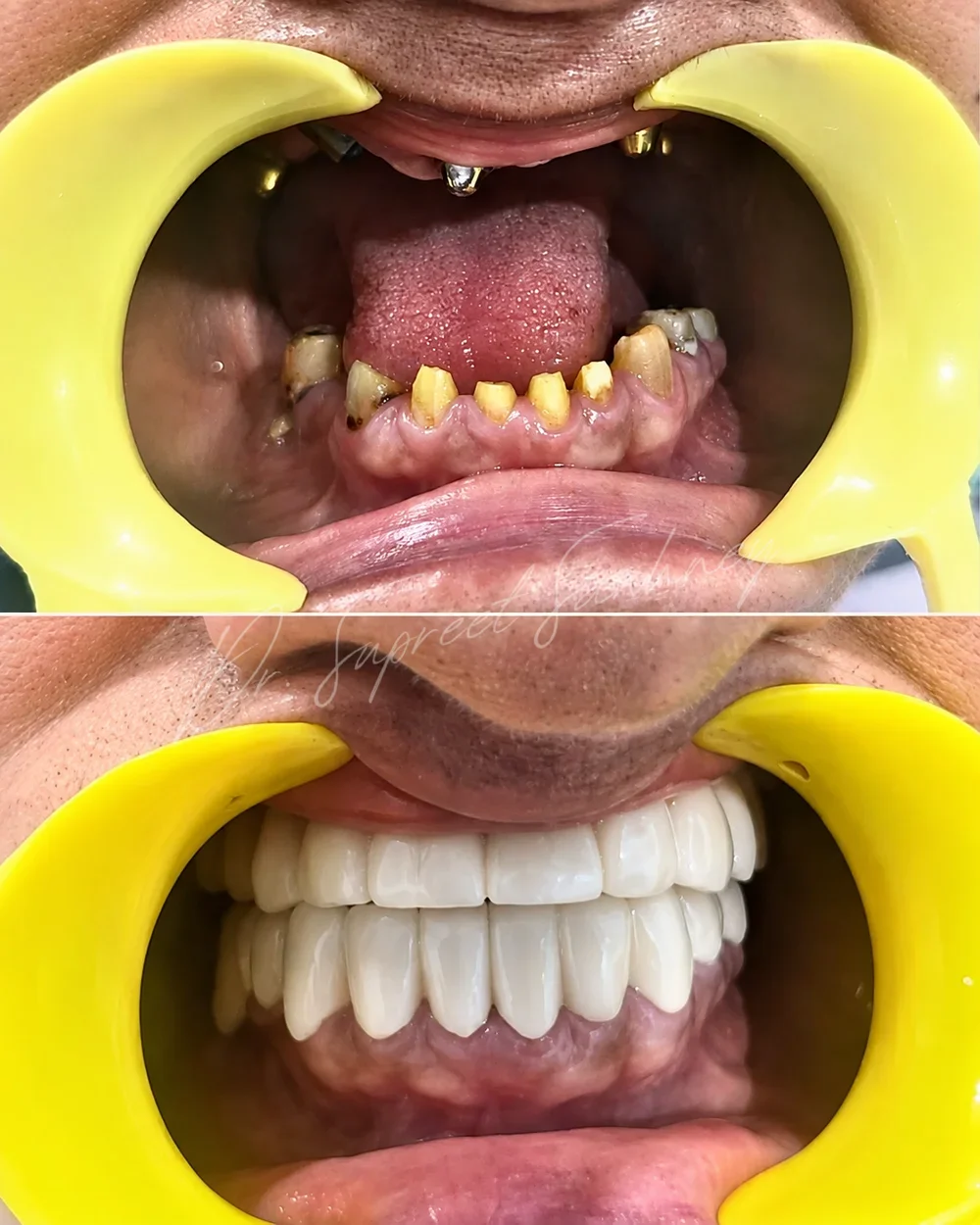 Before-and-after intraoral photographs from a full-mouth fixed rehabilitation case